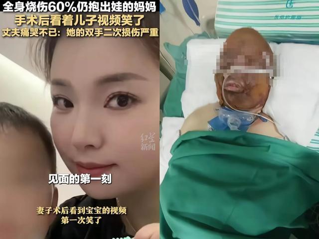 被烧伤女子为治疗剃头发 丈夫也剃头 患难见真情