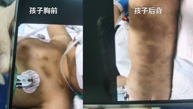 被虐致死男童生父称没想到这么严重 尸检证实三岁男童被生父女友虐待致死