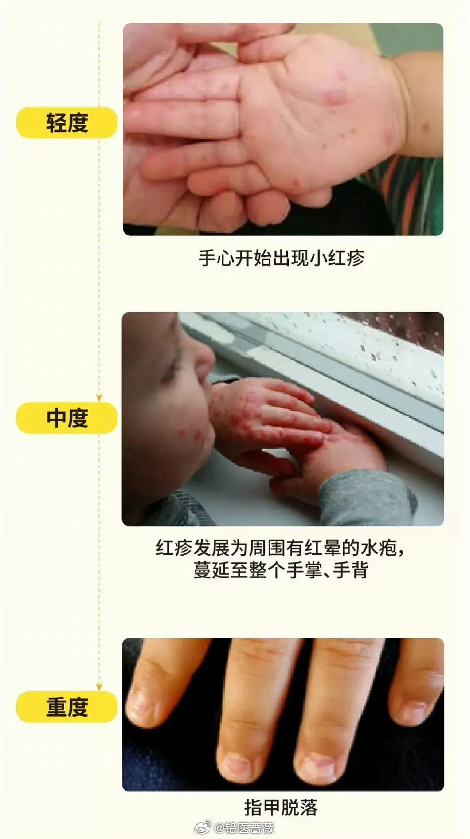 一间幼儿中心爆发手足口病新增两名病人 累计涉8名学童情况稳定